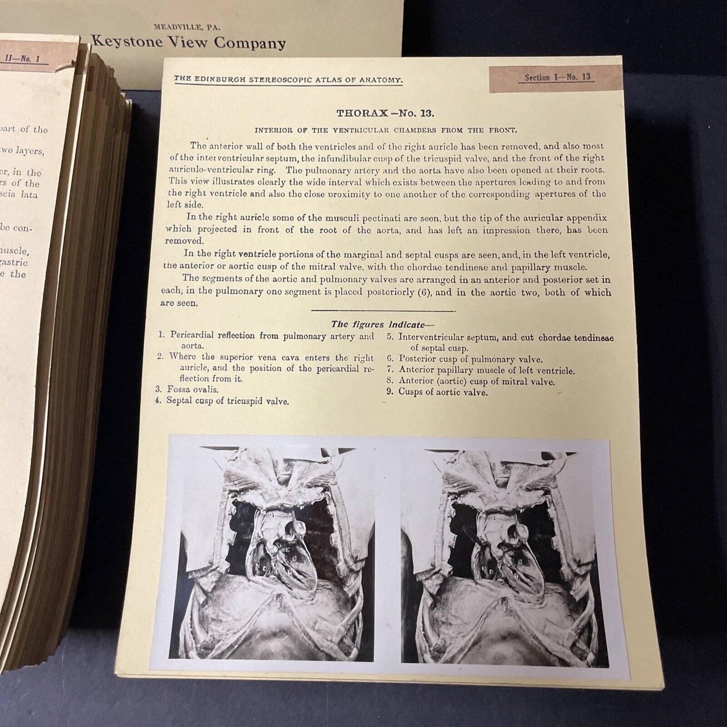 Internal Medicine Anatomy Stereoview 80pc Set Surgical Autopsy Antique 1911