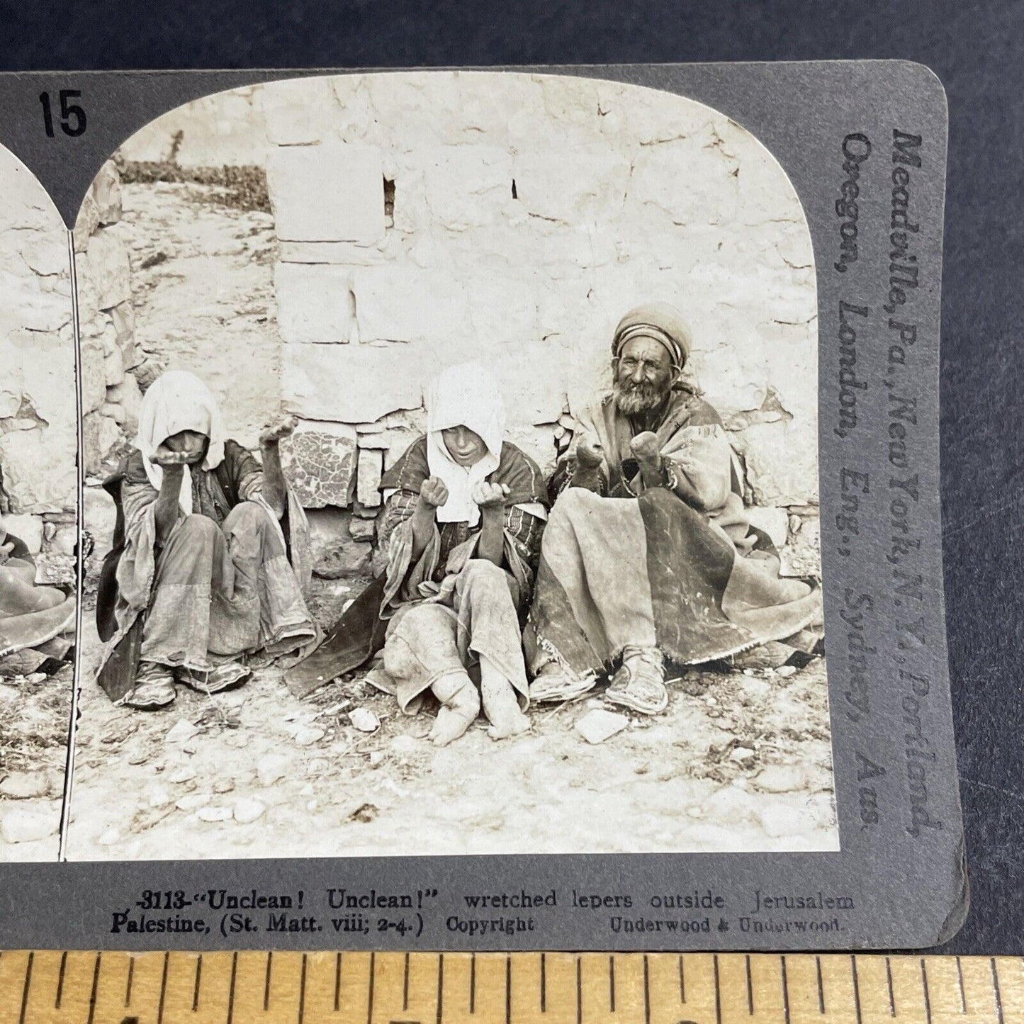 Antique 1906 Hands Severed From Leprosy Lepers Stereoview Photo Card P4448