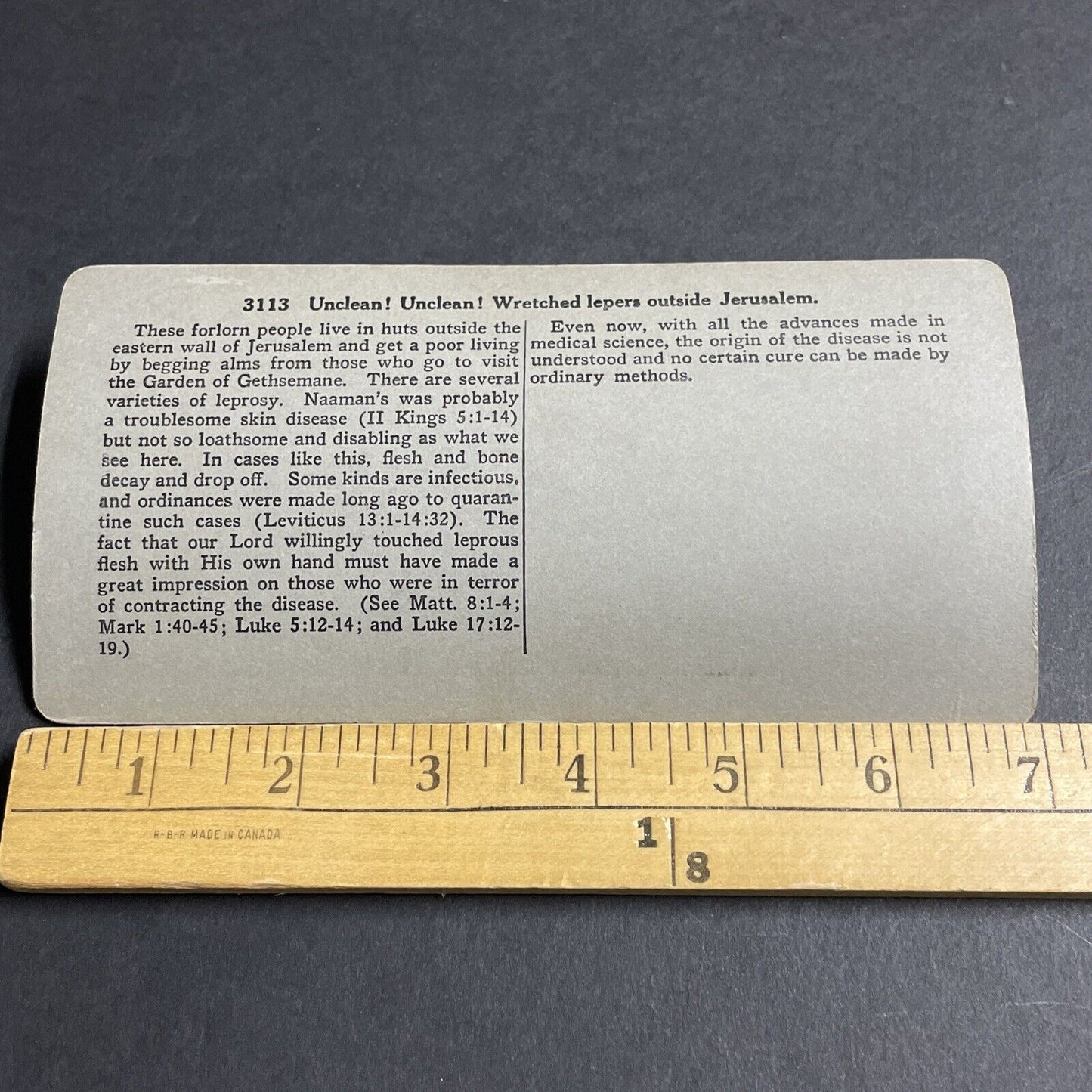 Antique 1906 Hands Severed From Leprosy Lepers Stereoview Photo Card P4448