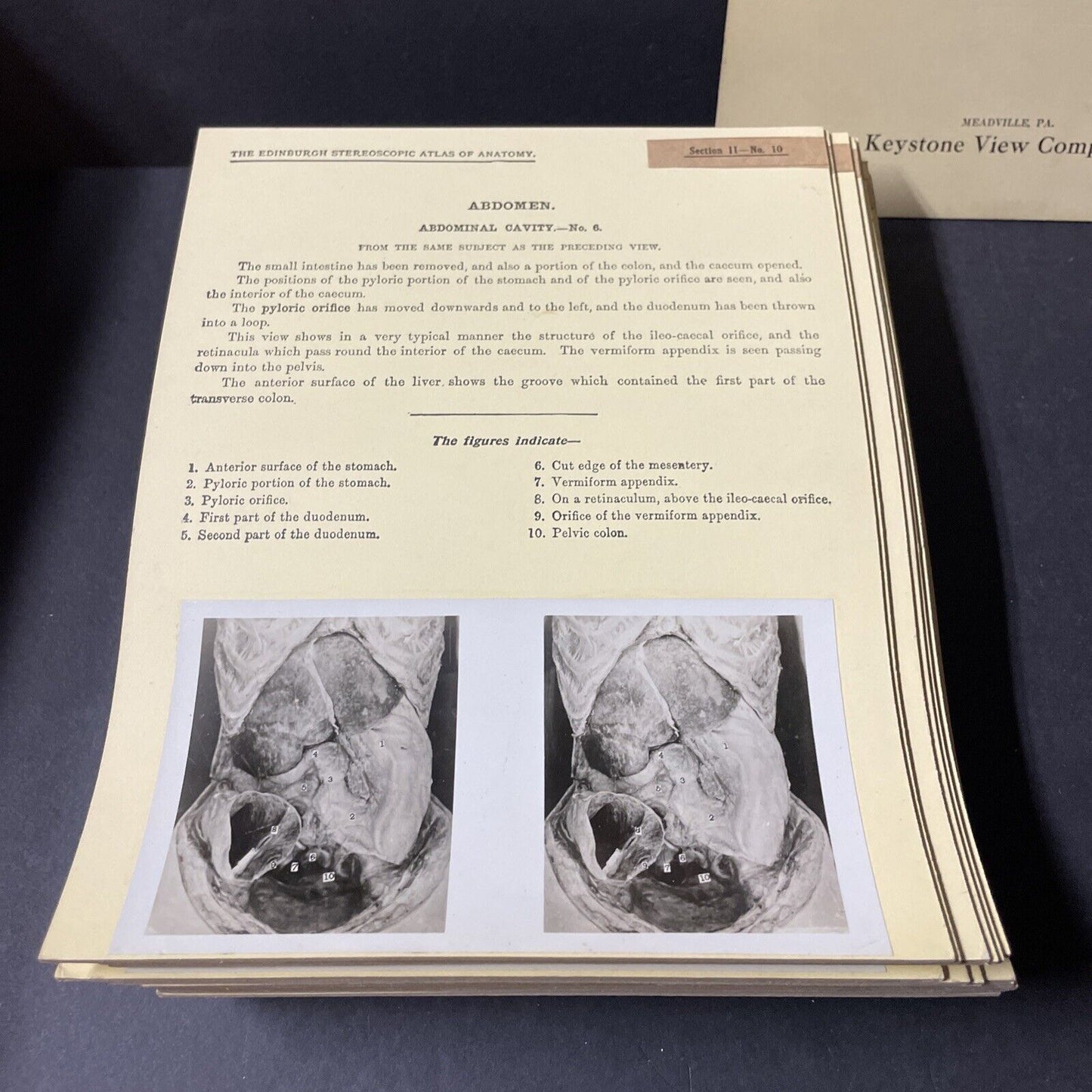 Internal Medicine Anatomy Stereoview 80pc Set Surgical Autopsy Antique 1911