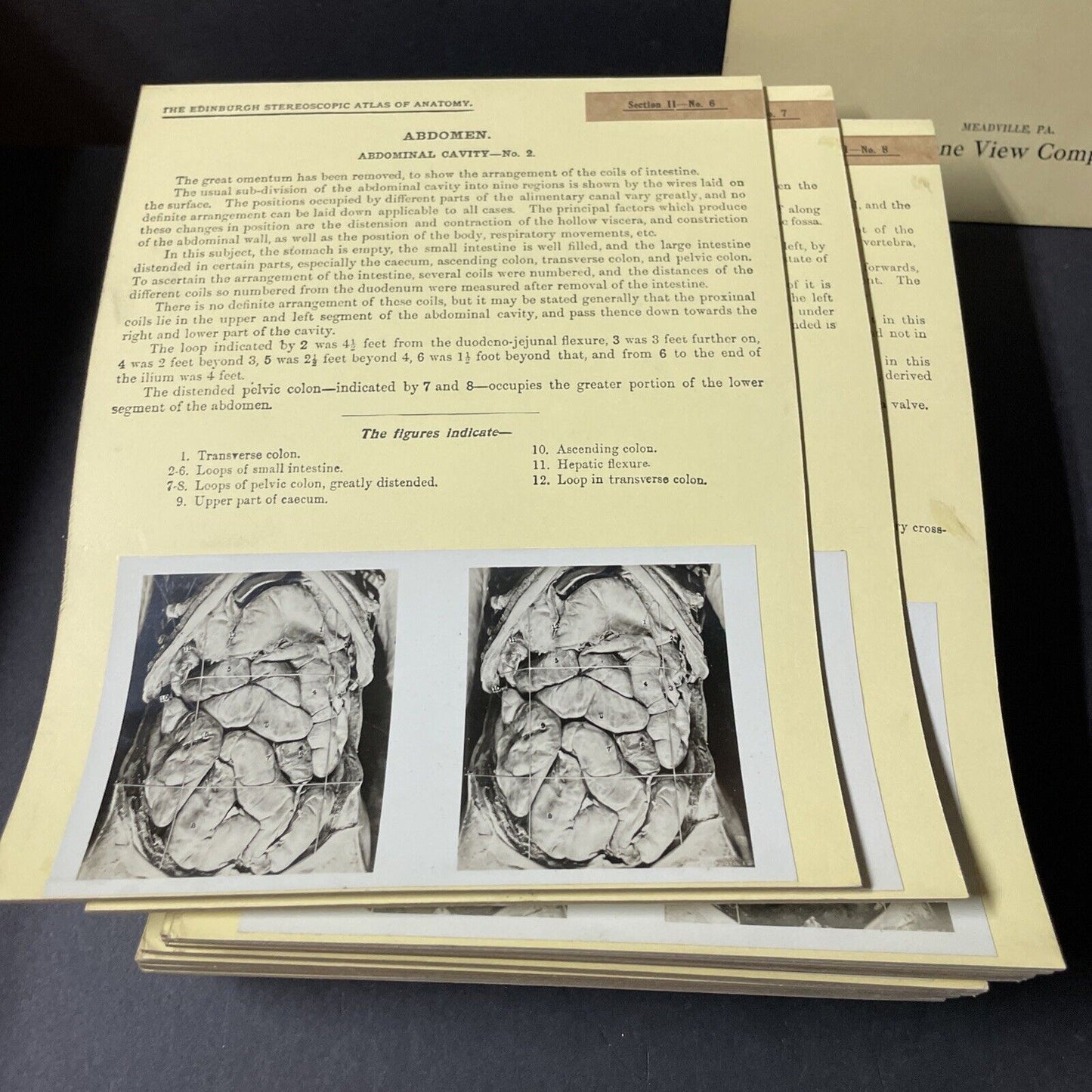 Internal Medicine Anatomy Stereoview 80pc Set Surgical Autopsy Antique 1911