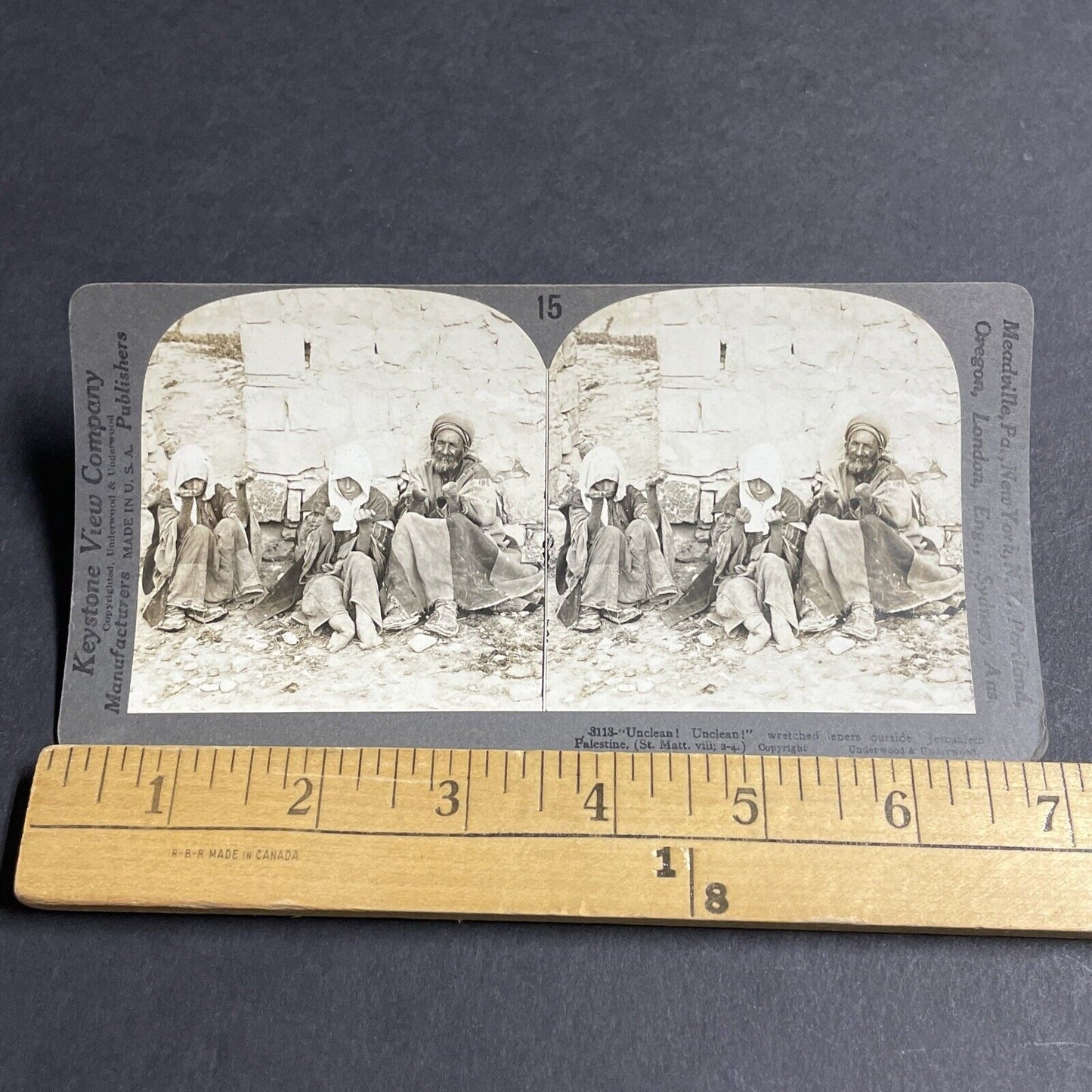 Antique 1906 Hands Severed From Leprosy Lepers Stereoview Photo Card P4448
