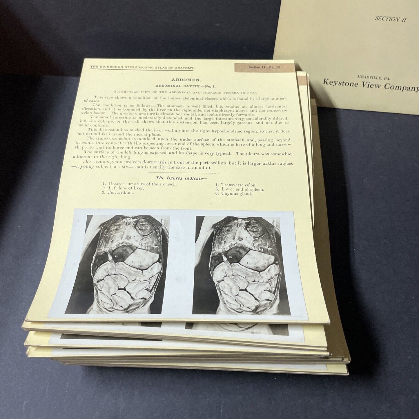Internal Medicine Anatomy Stereoview 80pc Set Surgical Autopsy Antique 1911