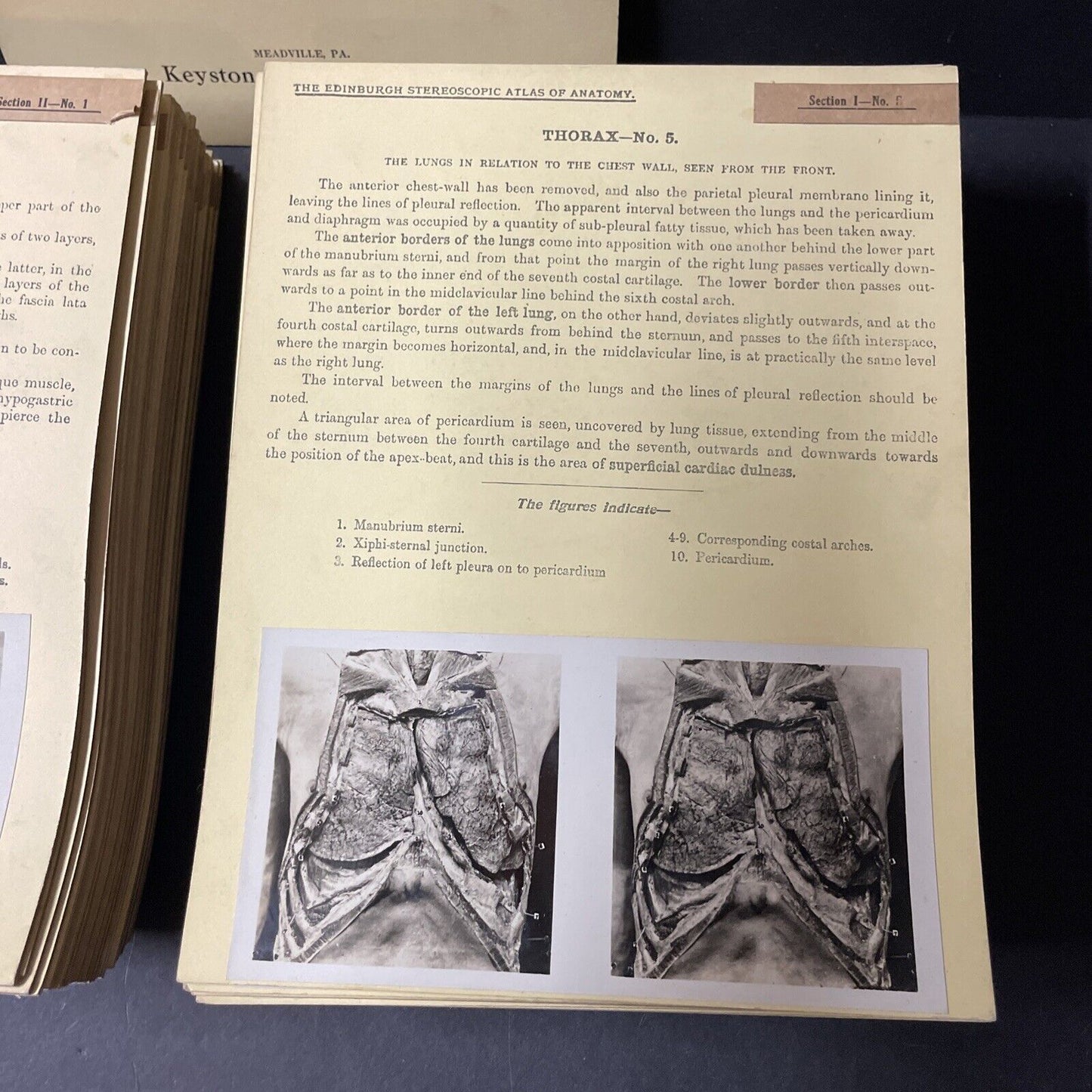 Internal Medicine Anatomy Stereoview 80pc Set Surgical Autopsy Antique 1911