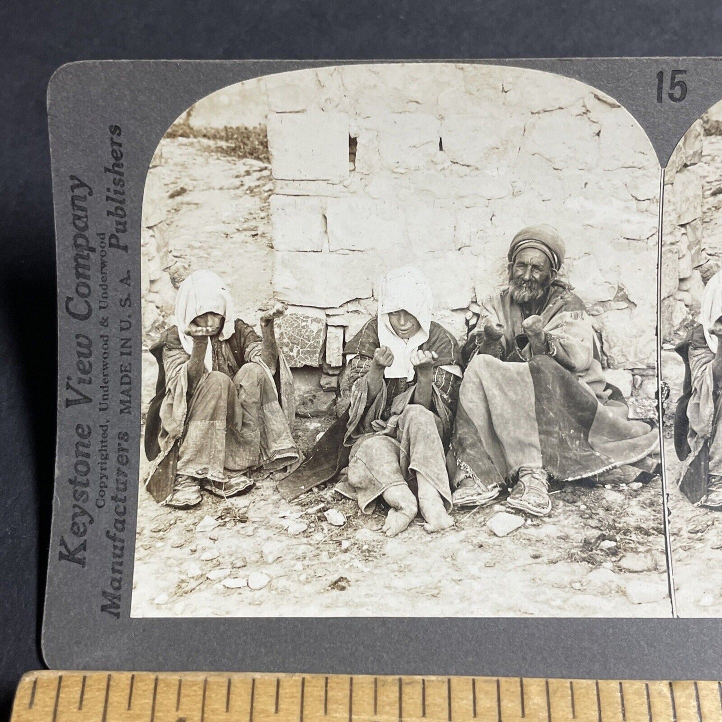Antique 1906 Hands Severed From Leprosy Lepers Stereoview Photo Card P4448