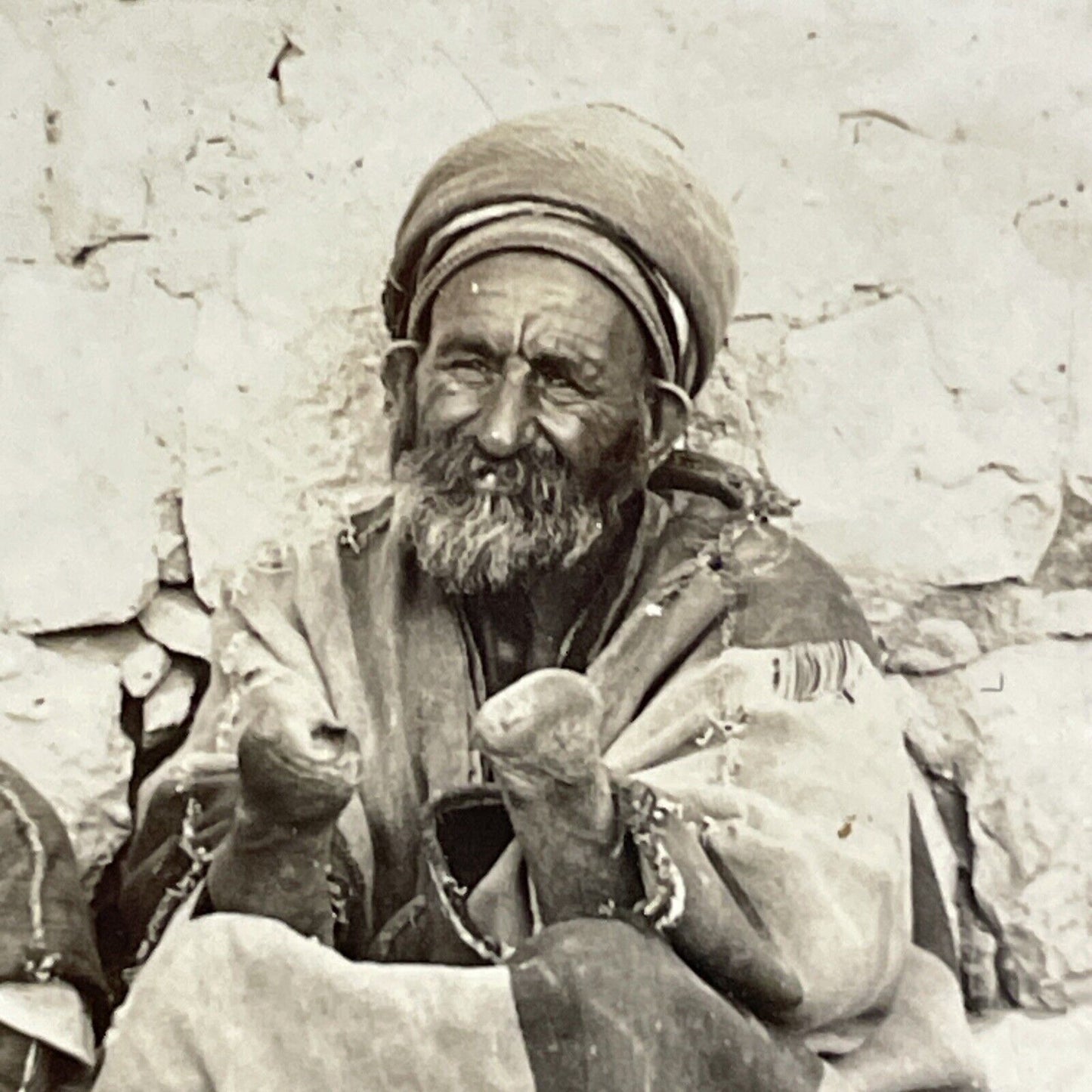 Antique 1906 Hands Severed From Leprosy Lepers Stereoview Photo Card P4448